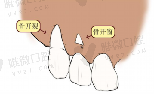 活动牙与活动假牙的区别,活动假牙是什么样的(图1)
